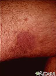 Kaposi sarcoma (ks) is a cancer that develops from the cells that line lymph or blood vessels. Kaposi Sarcoma Information Mount Sinai New York