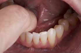 Some of what you have seen or heard about cancer may not. Self Oral Cancer Screening Socs Education Program School Of Dentistry Lsu Health New Orleans
