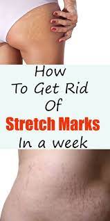 Bestmoisturizerforoilyskin In 2020 Stretch Marks Lighten Stretch Marks Body Skin Care Stretch Marks