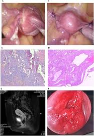 Image result for Uterine Inversion