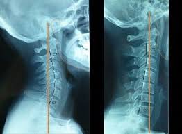 La osteopatía también es muy efectiva. Ejercicios Para Corregir La Rectificacion Cervical Fisioonline