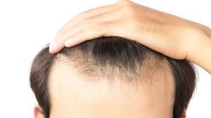 See more ideas about hair loss, hair loss treatment, hair loss remedies. Tips To Stop Hair Loss Tm Media Inc