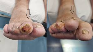 Image result for diabetic toes