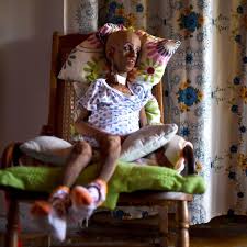 The aging process looks different for everyone, but there are certain components that are considered premature if you notice them before you turn 35. Crispr Cures Progeria In Mice Raising Hope For One Time Therapy Stat