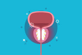 4 Cara Mengatasi Bph Benign Prostatic Hyperplasia