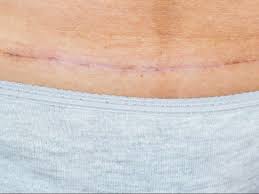 جرح العملية القيصرية بالصور توليد القيصريه وفتح البطن سحر الفخامة