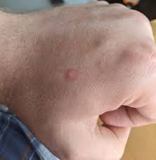 Image result for Fire Ant Sting