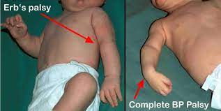 Check spelling or type a new query. Erb S Palsy Causes Symptoms Diagnosis Prognosis Erb S Palsy Treatment
