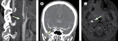 Stroke The Lancet