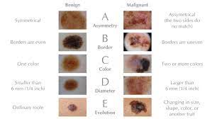 Skin cancer is one of the most common types of cancer. Know Your Abcdes Aim At Melanoma Foundation
