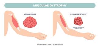 Image result for Myopathy