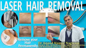 Some hair removal methods are limited to light skin tones. Laser Hair Removal In Kolkata I Laser Hair Removal Cost In Kolkata Youtube