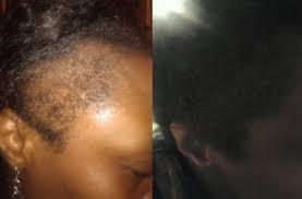 When it comes to black hair, many of us are living on the edge—literally and figuratively. How I Helped My Mom Regrow Her Edges In 5 Months Bglh Marketplace
