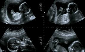 معرفة نوع الجنين بالسونار بالصور وشكل الجنين الذكر والأنثى زيادة