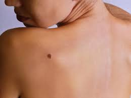 Over time, these rays can lead to wrinkles, dark over time, these injuries add up and lead to physical changes like wrinkles and skin cancer. How The Sun Causes Skin Cancer According To Science Allure