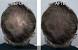Balding Thin Hair Men