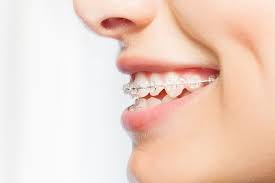 How to apply orthodontic wax for braces to protect your healthy teeth and gums, follow these steps to apply dental wax to your braces: Dental Wax Your Sidekick In Living With Braces Wees Low Orthodontics