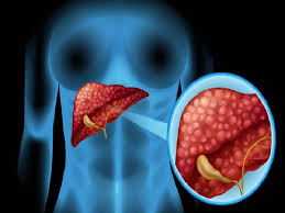 Hepatomegaly-Causes-Symptoms-Diagnosis-Treatment Optins-Dr-Qaisar-Ahmed-A Haytham Clinic-Risalpur-KPK-Pakistan