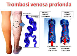 Emine kaplan için #acil b+pozi̇ti̇f #trombosi 0541 641 19 47 eşi pic.twitter.com/ovqcdnzost. Trombosi Venosa Profonda Condizioni Associate