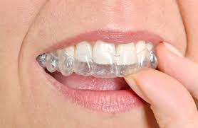 Scopri come avere denti allineati. Apparecchio Invisibile Per Adulti Guida All Ortodonzia Invisibile