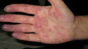 We did not find results for: Blaue Zehen Blaue Finger Arztekammer Nordrhein