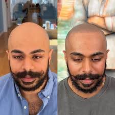 Haarverdichtung durch Pigmentierung der Kopfhaut