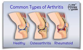 The Most Common Types Of Knee Arthritis Are Osteoarthritis And Rheumatoid Arthritis Knee Arthritis Rheumatoid Arthritis Arthritis