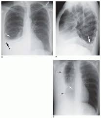 Nursing care plan 3 nursing diagnosis: The Pleura And Pleural Disease Radiology Key