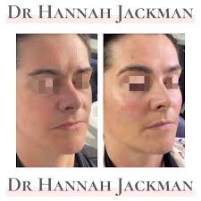 OGEE CURVE These are the S-shaped curves that are seen