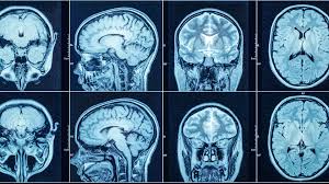 Magnetic resonance imaging (mri) is a scan that uses strong magnet and radio waves to see inside your body. Extending The Reach Of Mri With New Portable Brain Imaging Scanner Laptrinhx News