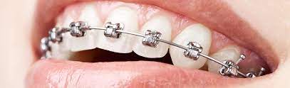 Self Ligating Braces Smarter Way To Get Straighter Teeth Zen Dental Health Care