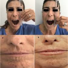 Changed in the Incisor-incisor mouth opening two years after infusion...