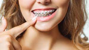 Top 10 Remedies For Braces Pain Relief