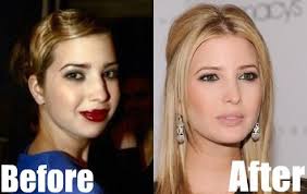 Plastic surgery patients have a new role model: Celebrity Plastic Surgery Plastic Surgery Perfect Nose