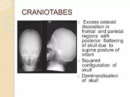 Image result for Craniotabes