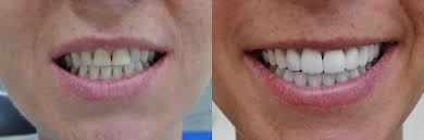 Veneers Fur Die Zahne Kosten Arten Vor Und Nachteile Fur Die Zahne