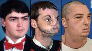 Face transplant recipient finally speaks