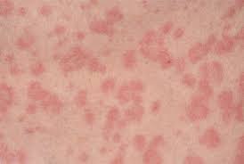 It was first identified in december 2019 in wuhan,. Skin Rashes Red Flag Symptoms Gponline