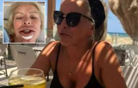 My lips exploded with pus after £60 botched fillers pierced a blood vessel  and left me permanently disfigured