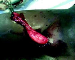 Résultat de recherche d'images pour "penis degloved"