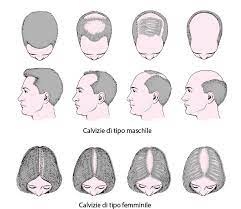 La caduta dei capelli può dipendere da ormoni, alimentazione, stress, fumo, alcol, sole, inquinamento e ai cosmetici che usi! I Fatti In Breve Perdita Dei Capelli Manuale Msd Versione Per I Pazienti