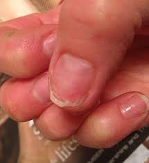 Why does acrylic nail hurt? Why Your Manicure Could Ruin Your Nails For Life Horror Stories Range From Weeping Sores And Bleeding Nail Beds To Skin Cancer Daily Mail Online