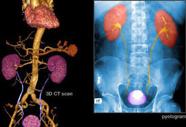However, some people present with other symptoms first because their urine color continues to remain normal. Bladder Cancer Symptoms Stages Treatment
