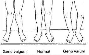 Image result for Genu Varum