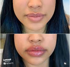 Lip Blushing Before and After: Real Results of Semi-Permanent Lip  Enhancement