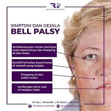 Dari hal ini mampu menyebabkan adanya perubahan pada bentuk area wajah, dimana wajah itu akan tampak melorot, dan tentunya kondisi ini mampu datang secara tiba tiba tapi meskipun begitu memiliki kebanyakan penderitanya hanya mengidap sifat sementara tapi juga ada yg. Apa Itu Bell S Palsy Bell S Teh Untuk Kencing Manis Facebook