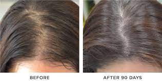 Generally speaking, finasteride is the best choice for men suffering from male pattern baldness, and minoxidil the only choice for women suffering from female. Hair Loss Compounded Medical Solutions For Men And Women