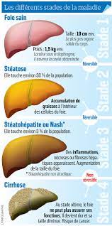 Certains l'appellent la maladie du soda, d'autres la maladie du foie gras. La Maladie Du Soda Un Fleau Mondial Le Parisien