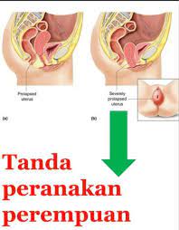 Antara sebab utama berlakunya penyakit batu karang ini adalah kekurangan air dimana air kencing menjadi pekat dan memudahkan pembentukan batu karang. Jamu Bonda 11 Simptom Rahim Jatuh 1 Sakit Ari Ari Facebook