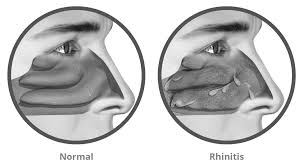 Image result for Rhinitis